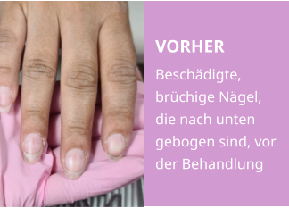 VORHER Beschädigte, brüchige Nägel, die nach unten gebogen sind, vor der Behandlung