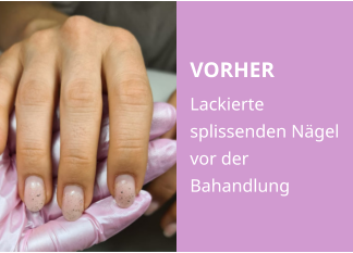 VORHER Lackierte splissenden Nägel vor der Bahandlung