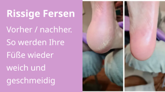 Rissige Fersen Vorher / nachher. So werden Ihre Füße wieder weich und geschmeidig