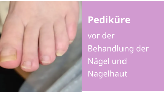 Pediküre vor der Behandlung der Nägel und Nagelhaut