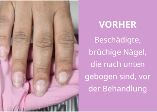 VORHER Beschädigte, brüchige Nägel, die nach unten gebogen sind, vor der Behandlung