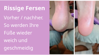 Rissige Fersen Vorher / nachher. So werden Ihre Füße wieder weich und geschmeidig