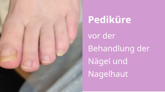 Pediküre vor der Behandlung der Nägel und Nagelhaut