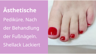 Ästhetische Pediküre. Nach der Behandlung der Fußnägeln.  Shellack Lackiert